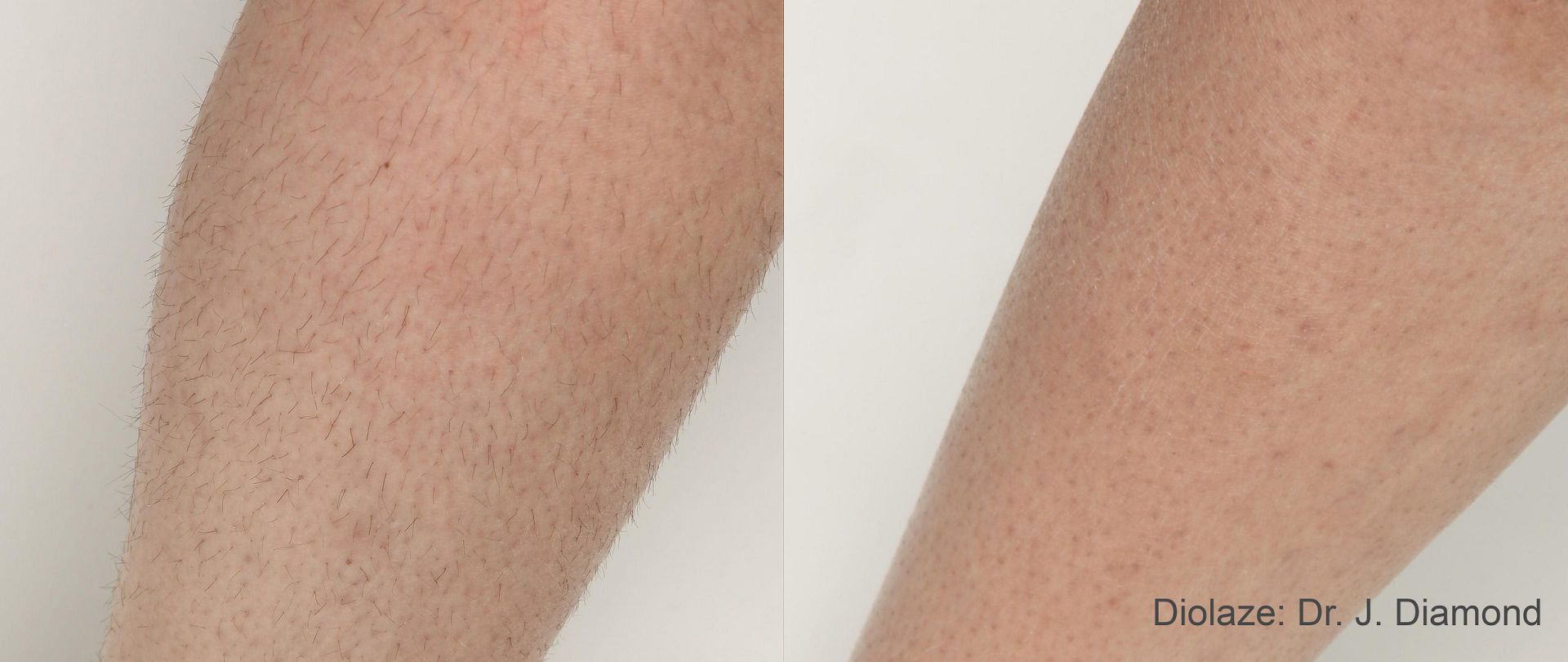 Diolaze_2a_2tx_2months_1st-and-2nd_30J_strongcooling_shortpulse-scaled